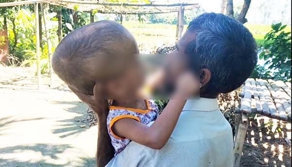শিশুর মাথা অস্বাভাবিক বড়, টাকার অভাবে বন্ধ চিকিৎসা