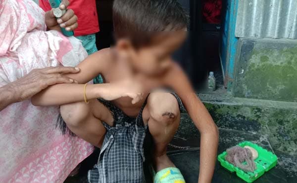 টাঙ্গাইলে পাগলা কুকুরের দৌরাত্ম্য, ২০ জন আহত