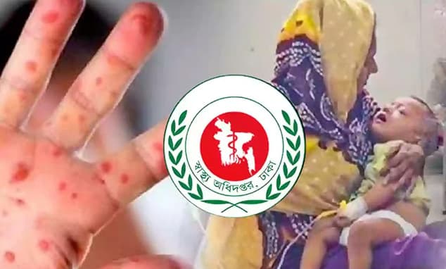 দেশে ২৪ ঘণ্টায় হাম উপসর্গে ৮ শিশুর মৃত্যু