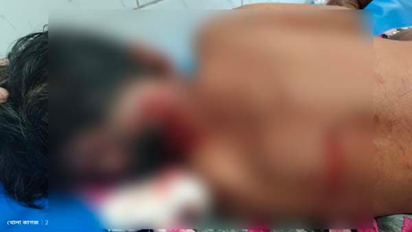 শ্রীমঙ্গলে বেওয়ারিশ কুকুরের কামড়ে তিন শিশু আহত, একজন আশঙ্কাজনক 