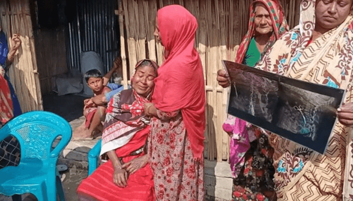 অপারেশনের পর পেটে কাঁচি রেখেই সেলাই, ২০ বছর পর ধরা