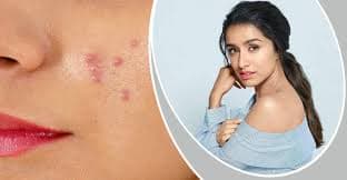মুখের ব্রণ দূর করবেন যেসব উপায়ে শ্রদ্ধা