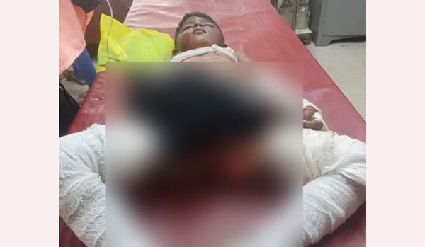 রোহিঙ্গা ক্যাম্পে গ্যাস সিলিন্ডার বিস্ফোরণ, ৫ শিশুসহ ৯জন দগ্ধ