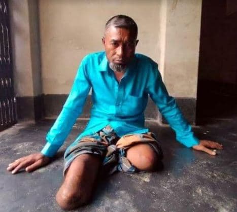 রাষ্ট্র খোঁজ রাখেনি দুই পা হারানো শাহানুরের