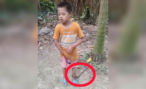 তজুমদ্দিনে শিকল দিয়ে গাছের সাথে বেঁধে প্রতিবন্ধী শিশুকে নির্যাতনের অভিযোগ