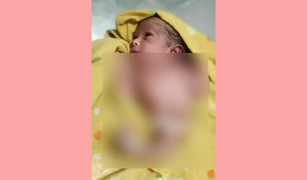 বিরামপুরে অদ্ভুত শিশুর জন্ম গ্রহণ