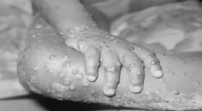 ‘মাঙ্কিপক্স’ নিয়ে দেশের সব বন্দরে সতর্কতা জারি