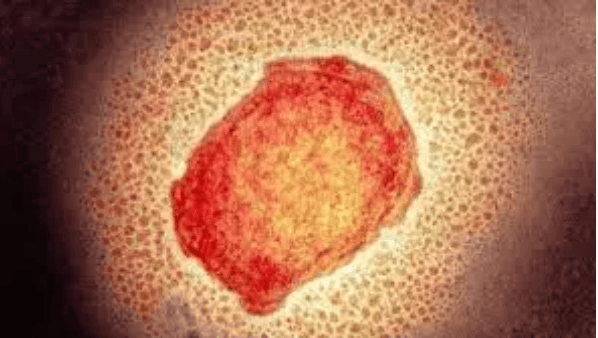 মাঙ্কিপক্স সন্দেহে ঢাকায় হাসপাতালে ভর্তি বিদেশি নাগরিক