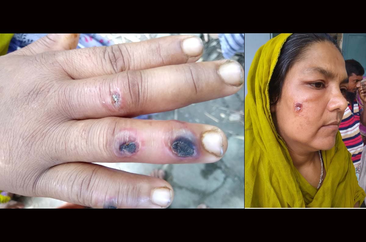 লালপুরে রোগাক্রান্ত গরু জবাই করে এক গ্রামের ৭ জন অসুস্থ