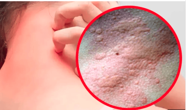 ঋতু পরিবর্তনের মাঝে অ্যালার্জি থেকে শিশুদের যেভাবে সুস্থ রাখবেন