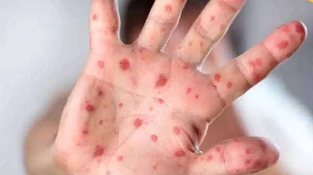 নতুন আতঙ্ক টমেটো ফ্লু! ভারতে আক্রান্ত ৮২