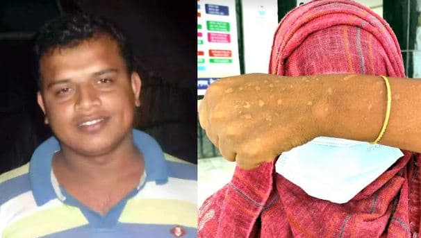 স্বামীর পরকীয়ায় তছনছ সংসার স্ত্রীর শরীরে কয়েলের ছ্যাকা!