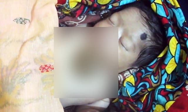 আগৈলঝাড়ায় শরীরের বাইরে হৃদপিন্ড নিয়ে শিশুর জন্ম