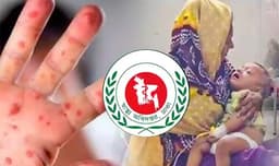 ২৪ ঘণ্টায় আরও হাম-উপসর্গে ১৩ শিশুর মৃত্যুর
