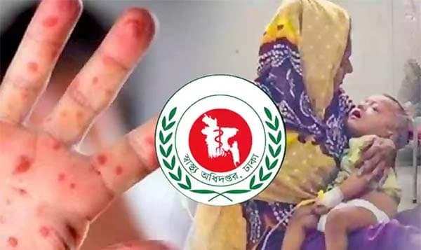 ২৪ ঘণ্টায় আরও হাম-উপসর্গে ১৩ শিশুর মৃত্যুর