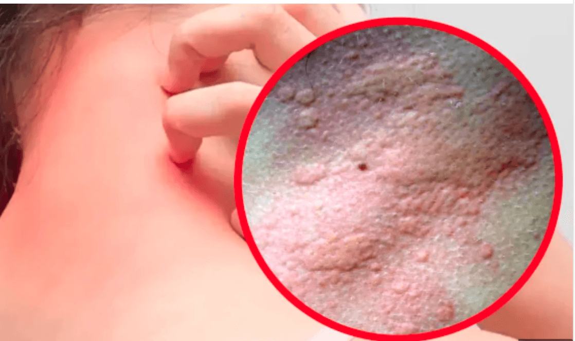 ঋতু পরিবর্তনের মাঝে অ্যালার্জি থেকে শিশুদের যেভাবে সুস্থ রাখবেন